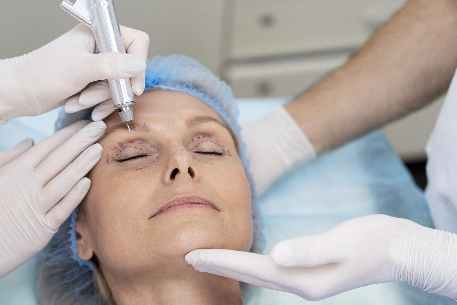 Blefaroplastia - Cirugía de párpados en Pamplona