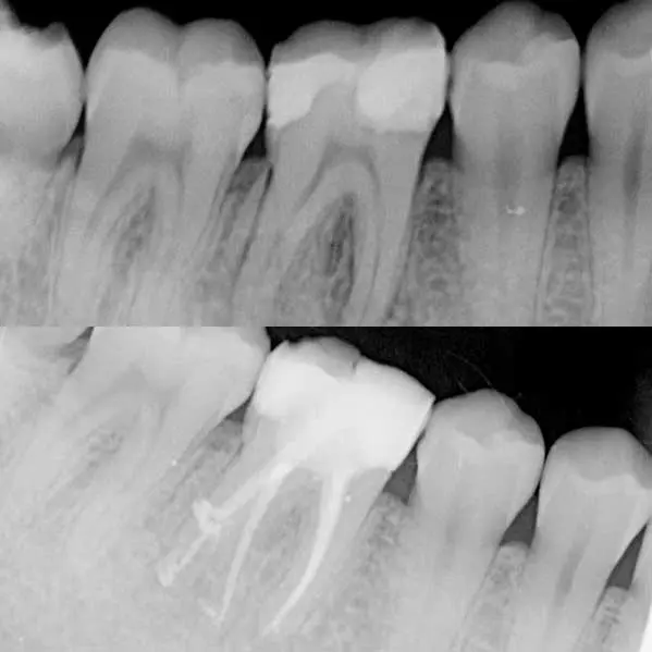 endodoncia en Logroño