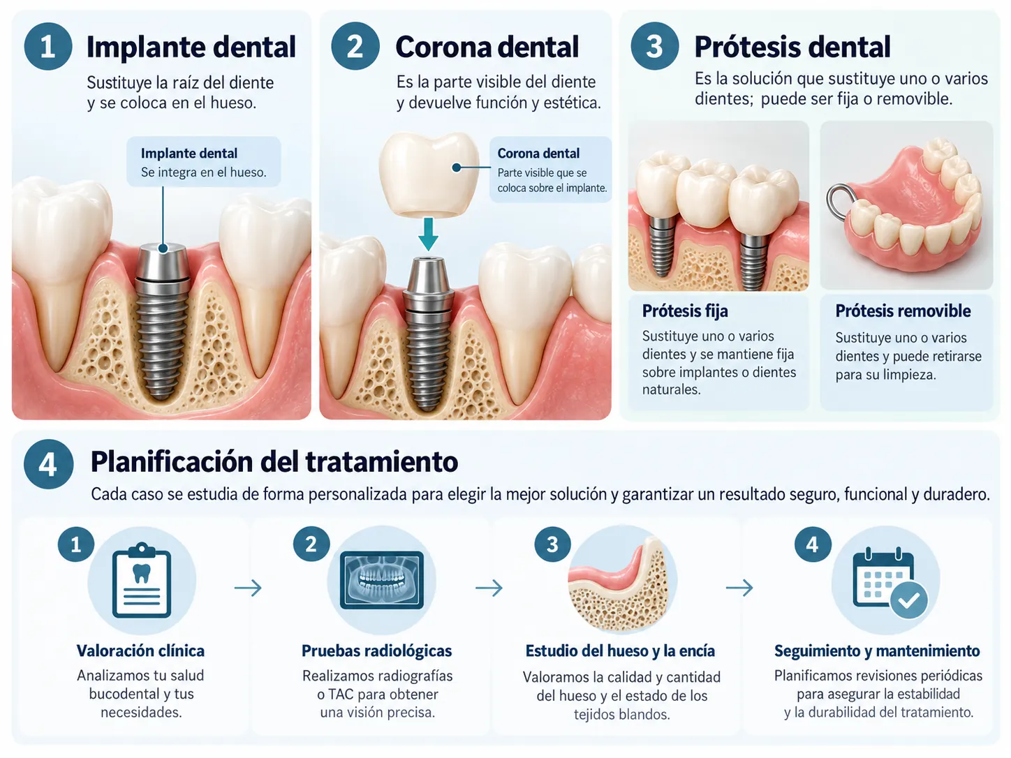 Infografía comparativa que muestra un implante dental, una corona y distintos tipos de prótesis dentales, con sus características y funciones.